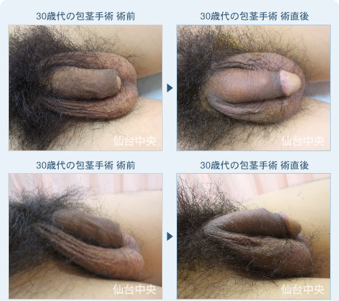 30歳代の包茎手術