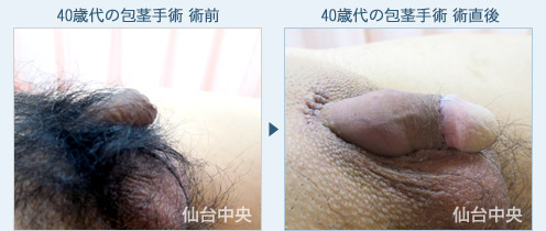 40歳代の包茎手術