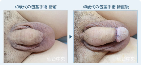 40歳代の包茎手術