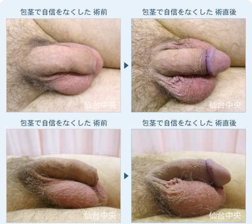 包茎で自信をなくした