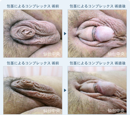 包茎によるコンプレックス