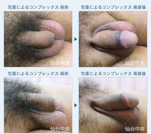 包茎によるコンプレックス