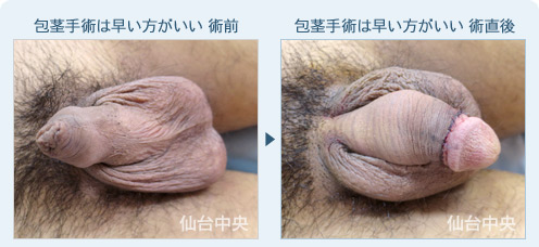 包茎手術は早い方がいい　症例写真1