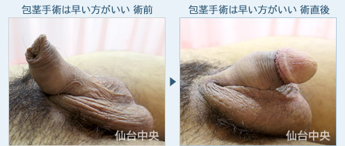 包茎手術は早い方がいい　症例写真2