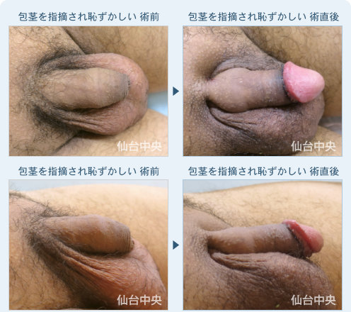 包茎を指摘され恥ずかしい