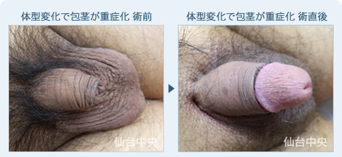 体型変化で包茎が重症化　症例写真1