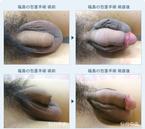 福島の包茎手術