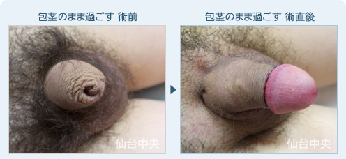 包茎のまま過ごす　症例写真1