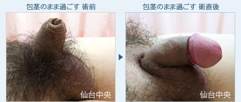 包茎のまま過ごす　症例写真2