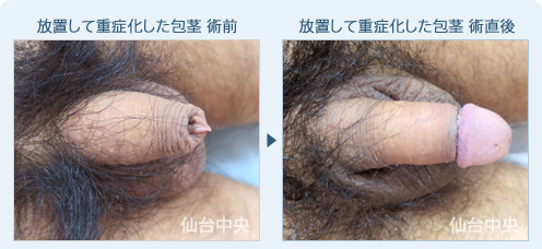 放置して重症化した包茎　症例写真1