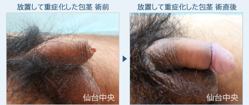 放置して重症化した包茎　症例写真2