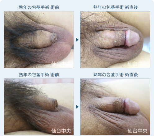 熟年の包茎手術 