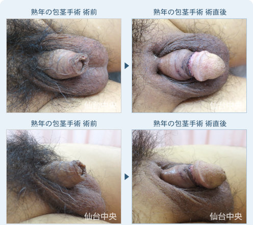 熟年の包茎手術 