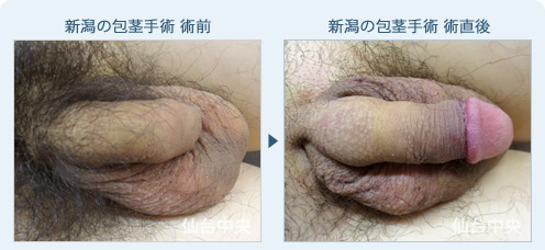 新潟の包茎手術 症例写真1