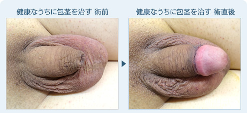 健康なうちに包茎を治す　症例写真1