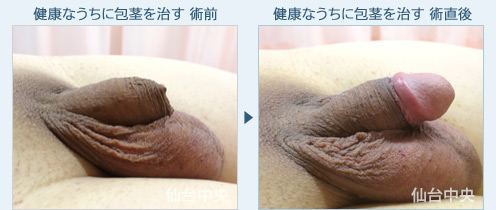 健康なうちに包茎を治す　症例写真2