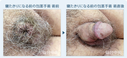 寝たきりになる前の包茎手術　症例写真1