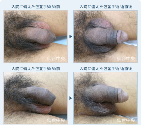 入院や介護に備えた包茎手術