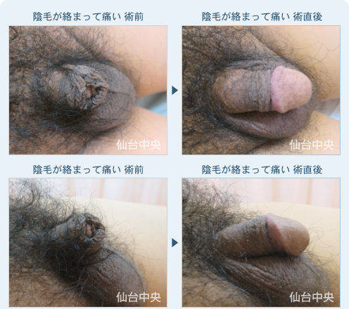 陰毛の絡まり 症例写真