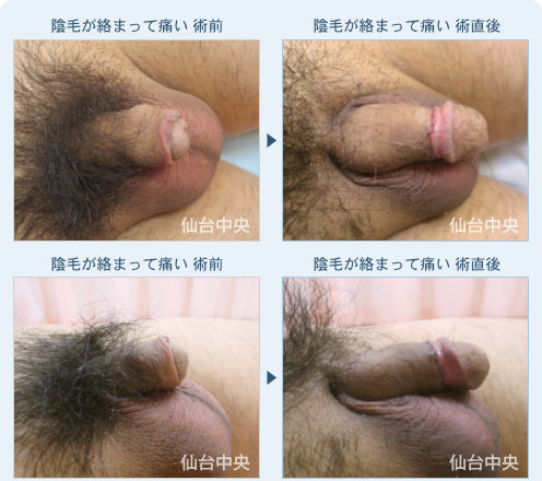 陰毛の絡まり 症例写真