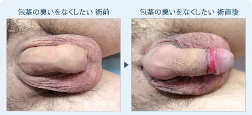 包茎の臭いをなくしたい　症例写真1