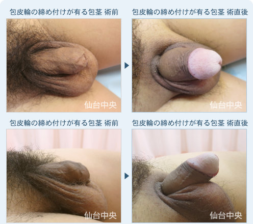 包皮輪の締め付けがある包茎