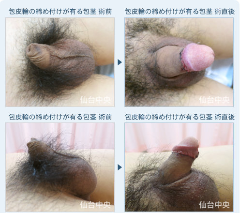包皮輪の締め付けがある包茎